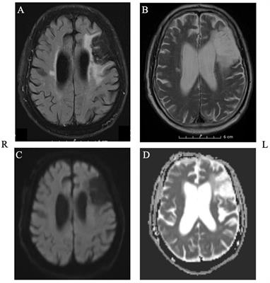 Case report: the effects of cerebellar tDCS in bilingual post-stroke aphasia